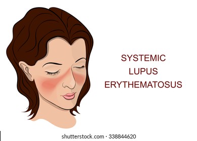 Illustration of the main symptom of SLE, purple butterfly on his nose and cheeks.