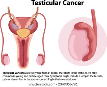Illustration of male anatomy with testicular cancer