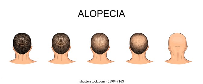 illustration of male head, alopecia