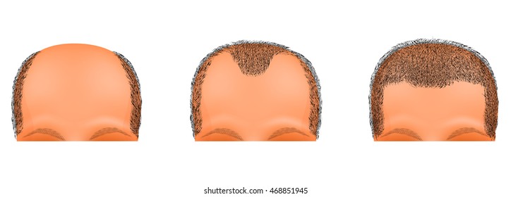 illustration of a male head suffering from baldness. hair transplantation
