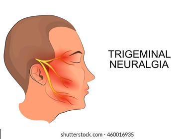 Illustration Of A Male Head. Trigeminal Neuralgia. Neuroscience
