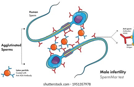 illustration of Male infertility or fertility test: Sperm Mar test.