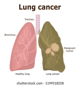 Illustration Of A Malignant Tumor - Lung Cancer