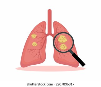 Illustration of a malignant tumor. lung cancer. concept of reparatory disease. vector illustration