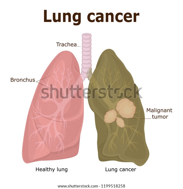 Illustration Malignant Tumor Lung Cancer Stock Vector (Royalty Free