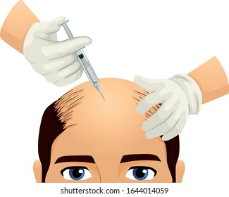 Illustration of a Man with Hair Fall Problem Receiving an Injection in the Head From a Pair of Hands Wearing White Gloves