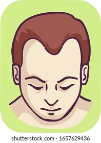 Illustration of a Man with M Pattern Baldness Hairline Loss