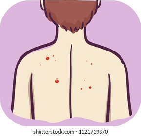 Illustration of a Man with Red Mole or Papule Growth on His Back