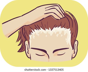 Illustration of a Man Showing Scaly Patches of Scalp