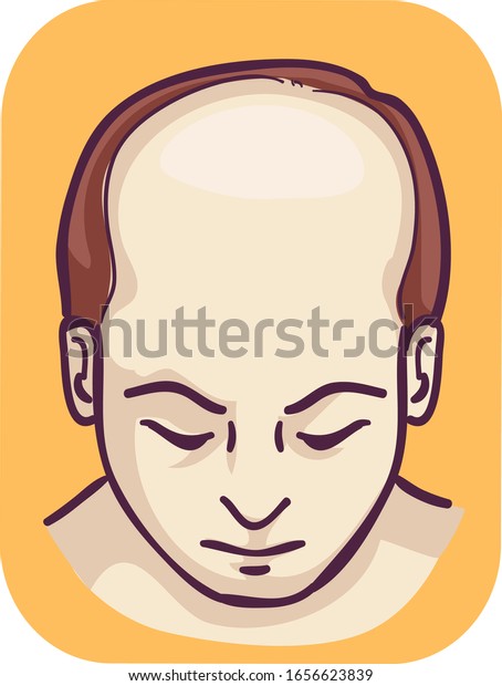 Illustration Man Top Hair Loss Male Stock Vector (Royalty Free ...