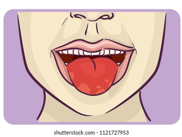 Illustration of a Man or Woman with Patches on Tongue