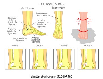 Illustration Mechanism Formation High Ankle Sprain Stock Vector ...