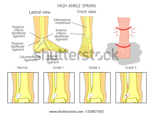 足首の高い捻挫 腱鞘性捻挫 足首の高い勾配の形成機構の図と 足首の外側と骨格 左右と正面図の図 のベクター画像素材 ロイヤリティフリー