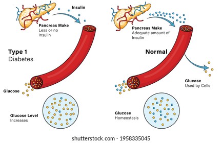 Illustration of mechanism of Type 1 diabetes or hyper glycemia. Hyperglycemia or high blood sugar. 