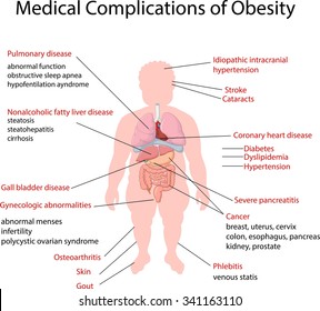 Illustration of Medical Complication of Obesity