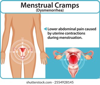 Illustration of menstrual cramps and uterine contractions