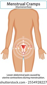 Illustration of menstrual cramps and uterine contractions