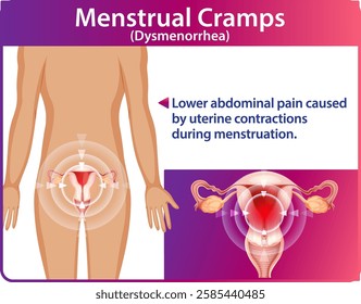 Illustration of menstrual cramps and uterine contractions