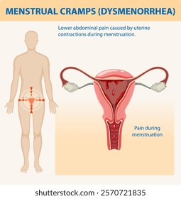 Illustration of menstrual pain and uterine contractions