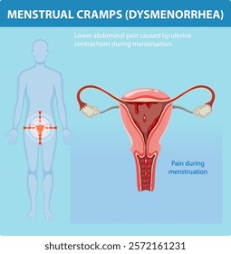 Illustration of menstrual pain and uterine contractions