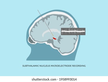 Illustration of microelectrode recording and brain waves recorded in subthalamic nucleus or STN for Parkinson disease surgery.