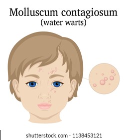 Illustration of Molluscum contagiosum on the face of a little girl