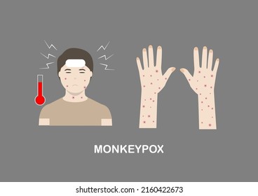 Illustration of monkeypox symptoms including fever, headache and rash on face, body and extremities.