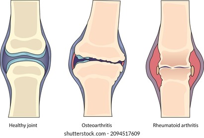 Illustration of  the most common form of arthritis. Infographic of Osteoarthritis,rheumatoid arthritis , and healthy joint - vector