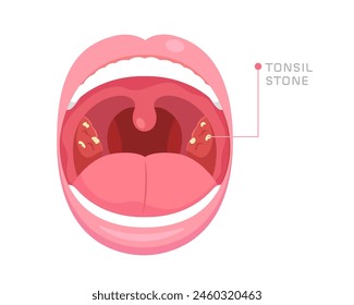 Illustration of mouth anatomy with tonsil stones in tonsil gland. Concept of bad breath, oral health, bacterial and viral infection at tonsil gland, sore throat, halitosis. Flat vector illustration.