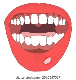 Illustration of a mouth with canker sores. Suitable for health articles, infographics, medical textbooks, dental clinic materials, or awareness campaigns about oral hygiene and health.