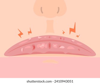 ilustración de una boca con labios rotos. labios secos, amordazados y descascarillados. estado de salud de labios. diseño de ilustración plana. elementos gráficos. vector