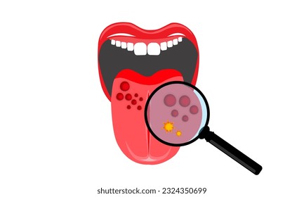 illustration of mouth and tongue examined with a magnifying glass due to infection and bacteria. papillomavirus on tongue or oropharyngeal cancer
