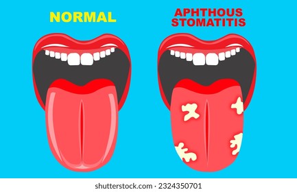 illustration of mouth and tongue problems with aphthous stomatitis. symptoms of oral disease Fungi on the tongue
