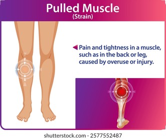 Illustration of muscle strain symptoms and causes