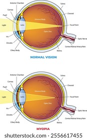 illustration of Myopia vs normal eye diagram - vector