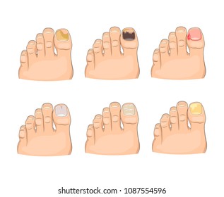 Illustration of nail diseases in neat and modern cartoon style