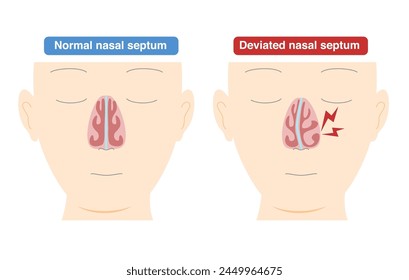 Illustration of nasal diaphragm curvature caused by deformation of the nasal diaphragm