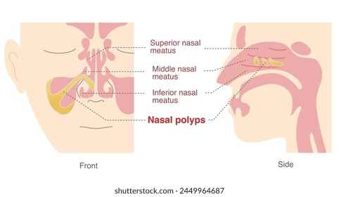 Illustration of nasal polyps in the sinuses from front and side views