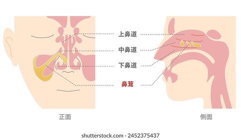 Illustration of nasal polyps in the sinuses from front and side views [TRANSLATE];Nasal polyps, Superior meatus, Middle meatus, 
Inferior  meatus, 