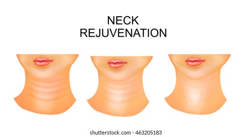 Illustration Of Neck, Wrinkles, Rejuvenation
