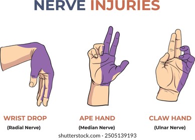 Illustration of nerve injuries in hand - vector