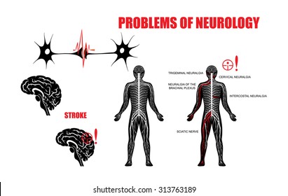 Illustration of the nervous system and neurological diseases. Brain, stroke, trigeminal neuralgia, cervical plexus neuralgia, neuralgia of the brachial plexus, intercostal neuralgia and sciatic nerve.