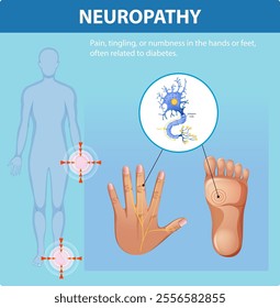 Illustration of neuropathy affecting hands and feet
