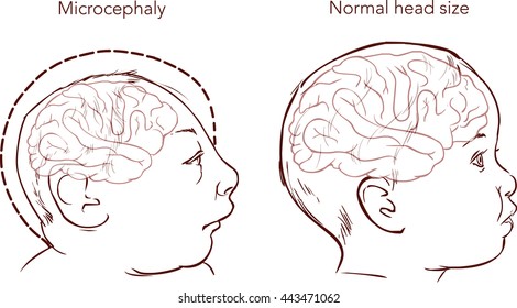 Illustration Of A Newborn Baby With Microcephaly Disease Caused By Zika Virus