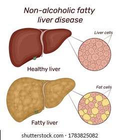 Illustration of non-alcoholic fatty liver disease. For comparison shows the healthy and diseased liver