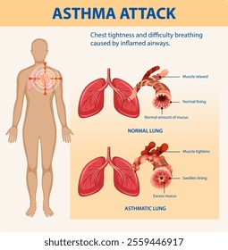 Illustration of normal and asthmatic lung conditions