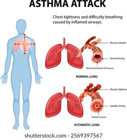 Illustration of normal and asthmatic lung conditions