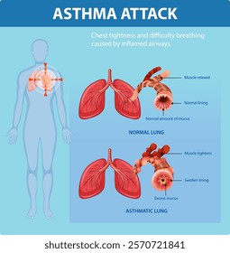 Illustration of normal and asthmatic lung conditions