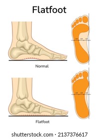 2,668 Lateral foot Images, Stock Photos & Vectors | Shutterstock