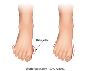 Illustration of the normal foot and hallux valgus. Human foot deformity. Hallux valgus and tailors bunion.